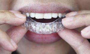 Clear braces Invisalign